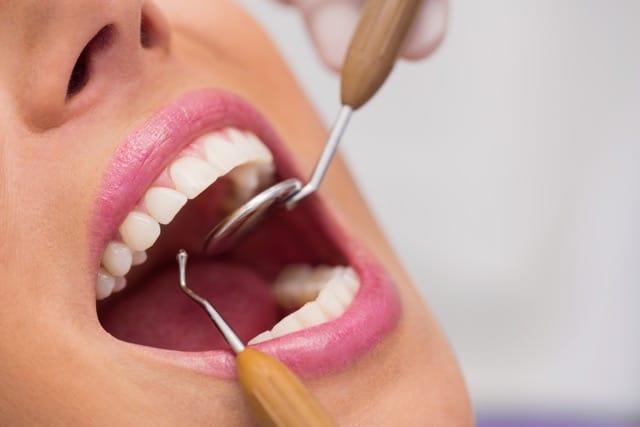 Tratamiento de gingivitis y periodontitis en Instituto Dental ABAD, Murcia